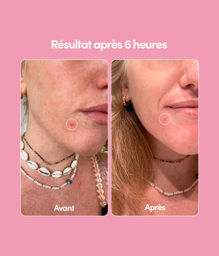 MERCI HANDY Unicorn Edition Patch Bouton 24 piece لصقات لمعالجة شوائب البشرة من ميرسي هاندي - Image 5