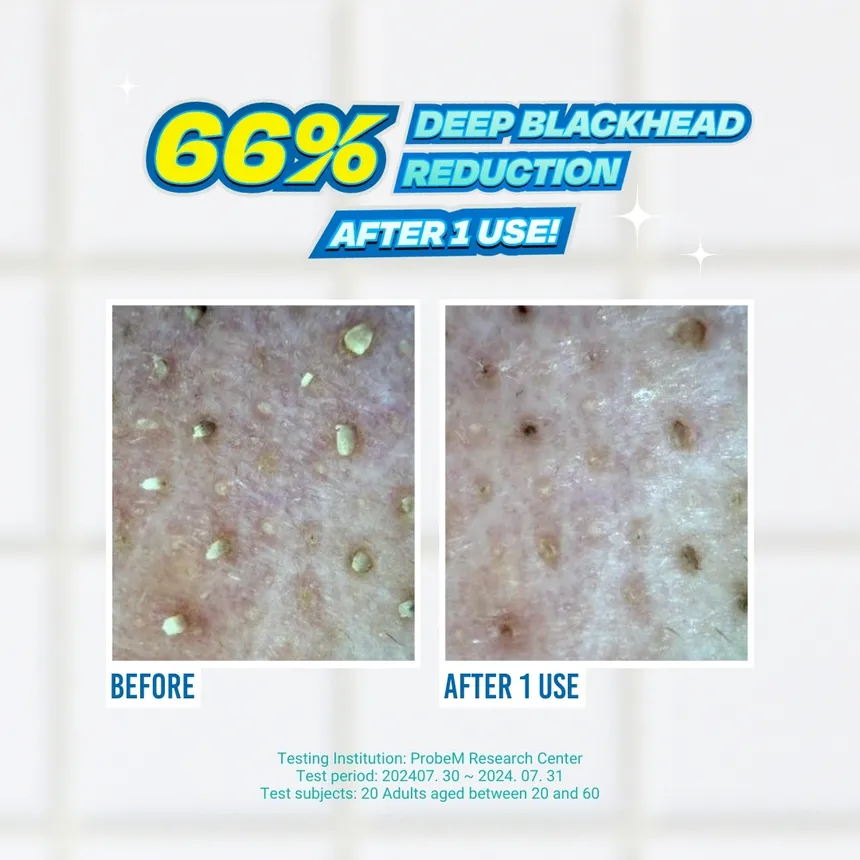 JUMISO Blackhead Melting Softener Special Kit جوميسو مجموعة لإزالة الرؤوس السوداء وتنعيم البشرة - Image 4
